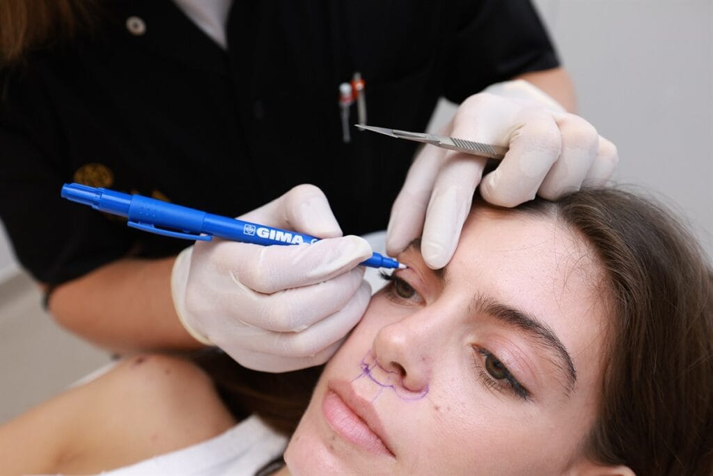 Blefaroplastia superioară chirurgicală