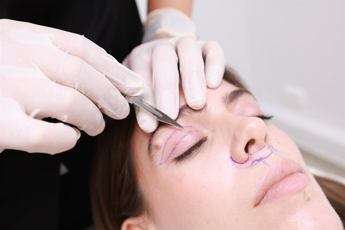 Blefaroplastia superioară chirurgicală 1 Blefaroplastia superioară chirurgicală