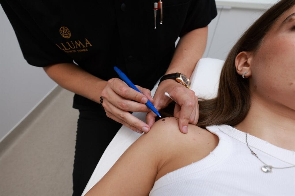 Excizia nevilor pigmentari