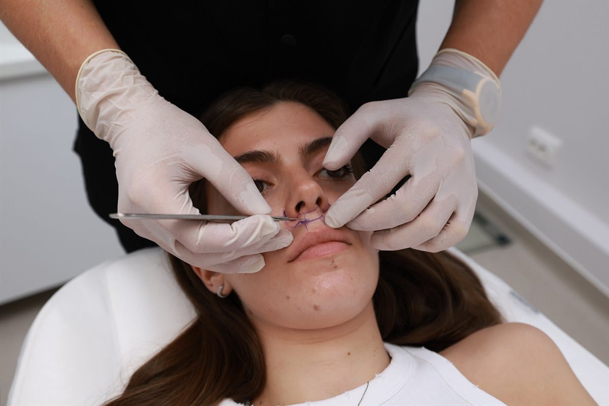 Lip Lift