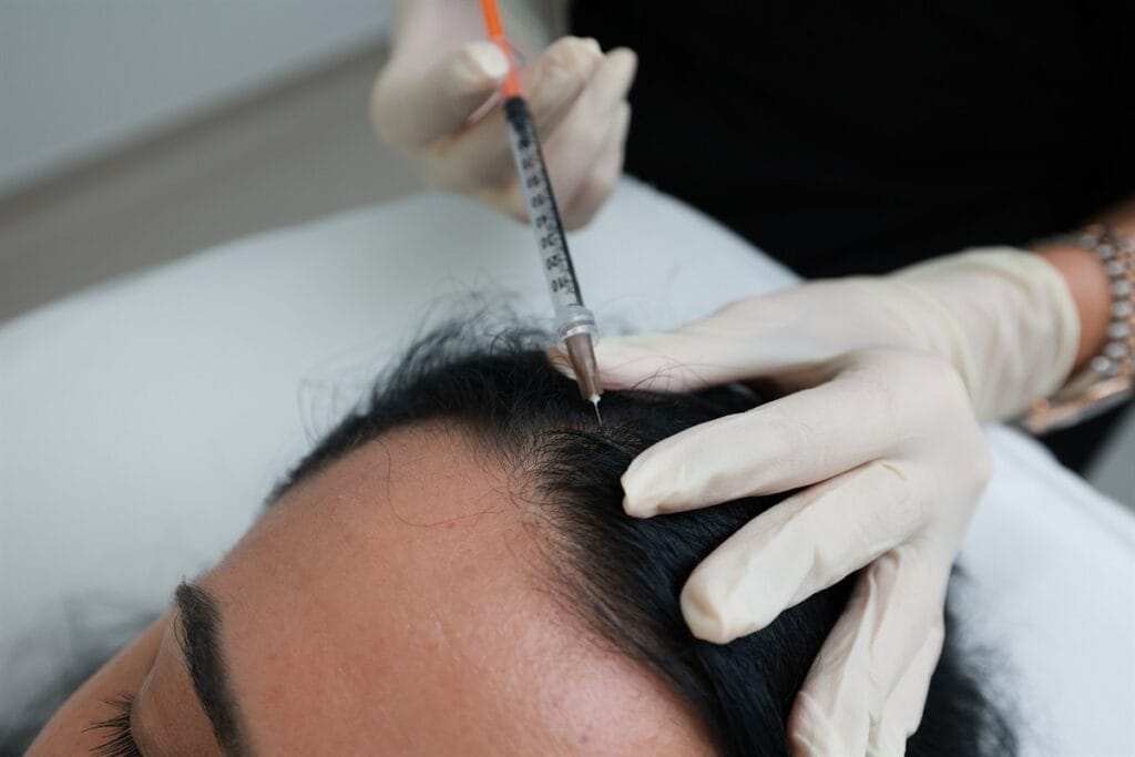 PRP - Scalp